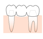 ブリッジ治療